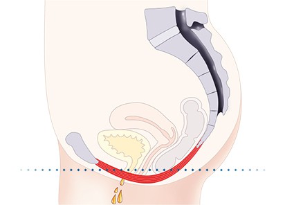 Pelvic-Floor Muscle Repair 5 Pelvic floor muscles Cumbernauld