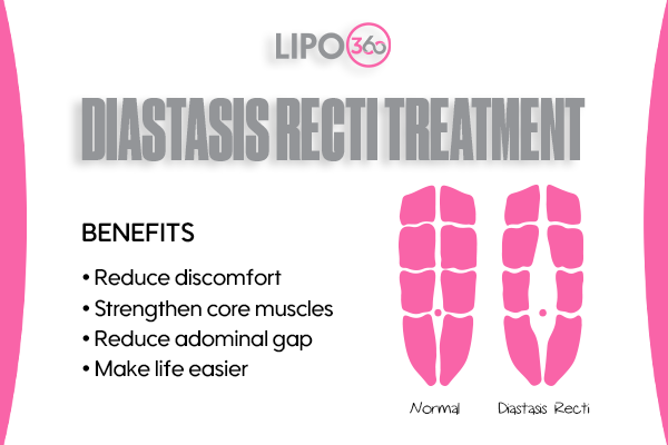 Revolutionising Muscle Repair: The Power of LIPO360 Body Sculpt Post-Injury 5 diastasis recti treatment Cumbernauld