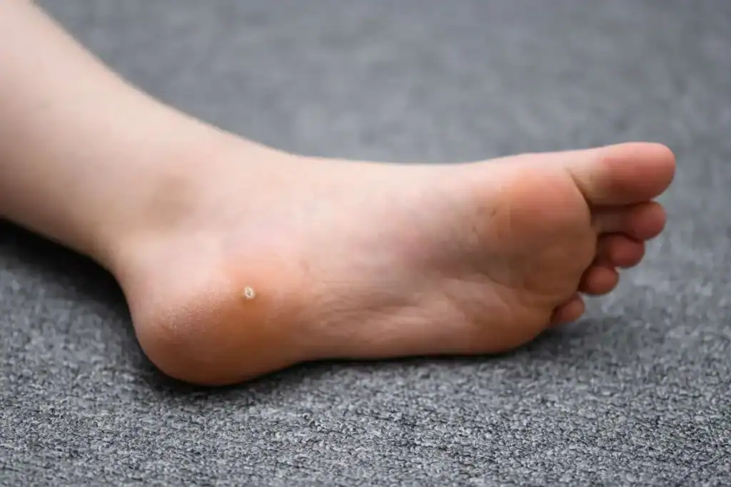 Cryotherapy For Warts And Also Verrucas 2 Image of verruca on the bottom of the foot that able to be treated with Cryotherapy Cumbernauld